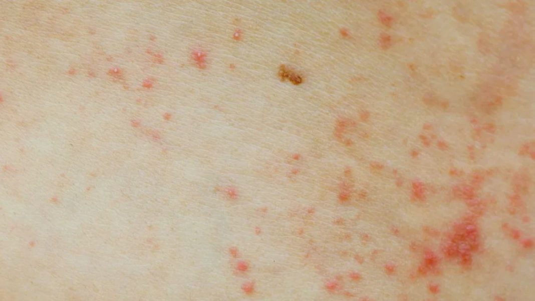 Itching Red Spots On Skin