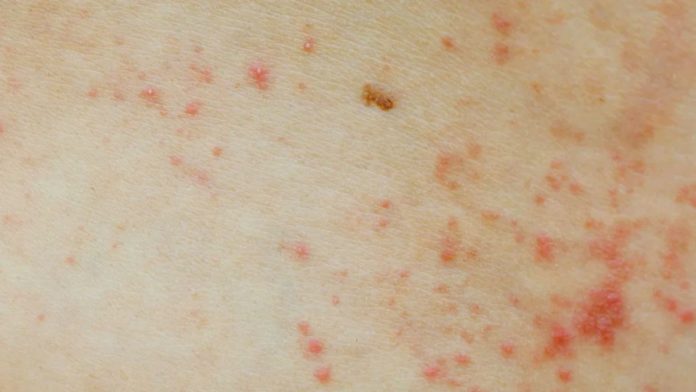 Itching Red Spots on Skin