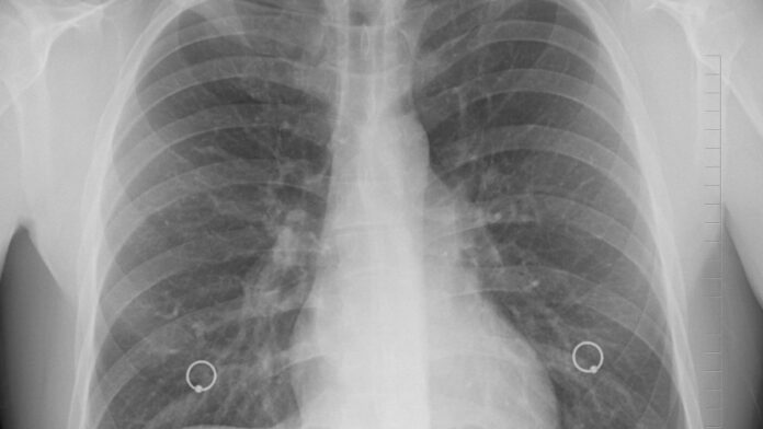 Smoker's Lungs X-Ray